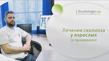 Промежуточные результаты экспериментальной программы консервативного лечения сколиоза у взрослых